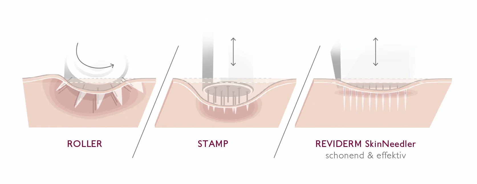 Schema-Vergleich der Einstich-Technik beim Microneedling: Roller mit schrägen Einstichen, Stamp mit eingedrückter Haut, REVIDERM SkinNeedler mit präzisen senkrechten Einstichen