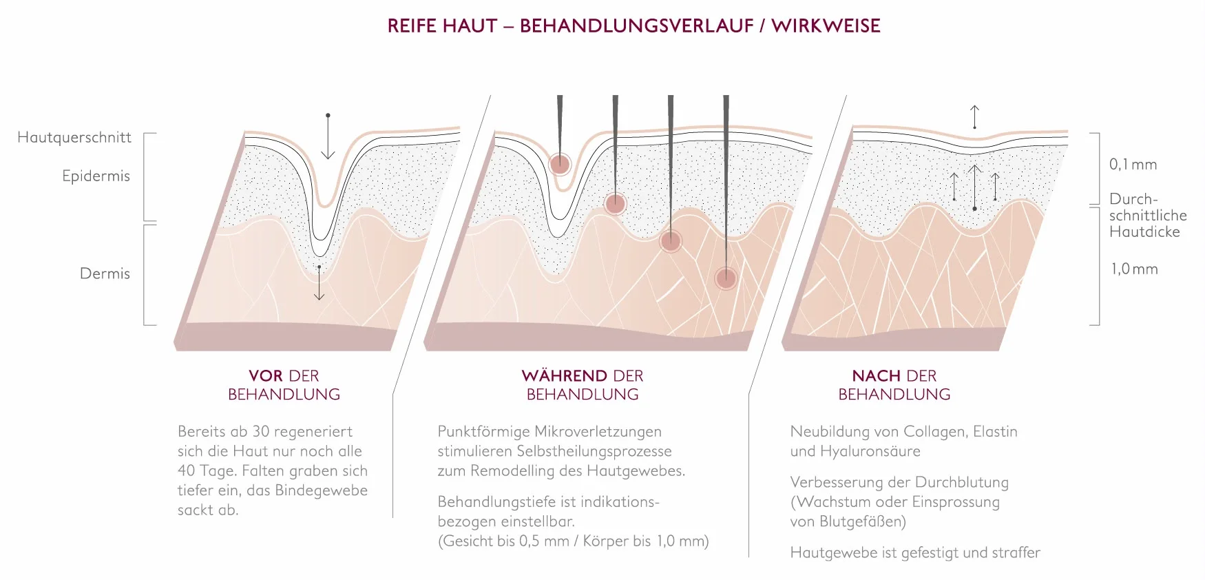 Hautquerschnitt in drei Schritten: vor, während und nach der Needling-Behandlung reifer Haut — punktförmige Mikroverletzungen stimulieren die Neubildung von Collagen, Elastin und Hyaluronsäure